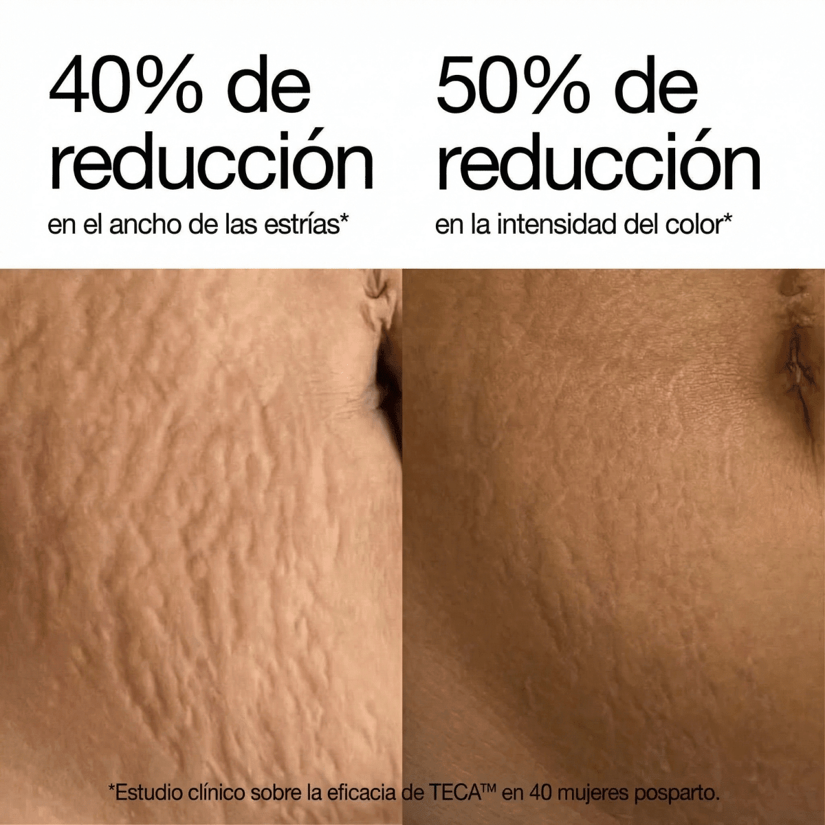 Redefiniendo la crema para estrías