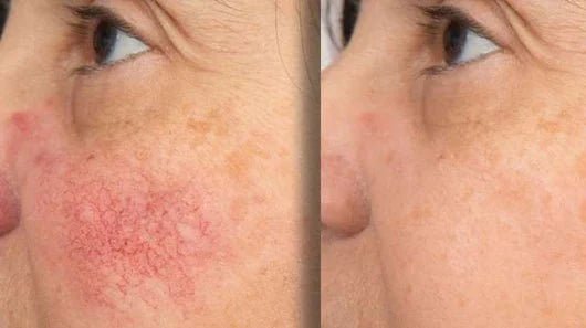 Solvia Sérum Anti-Rojeces